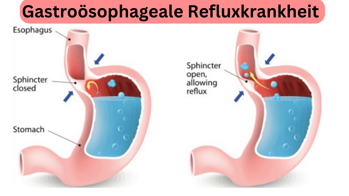Gastroosophageale-Refluxkrankheit