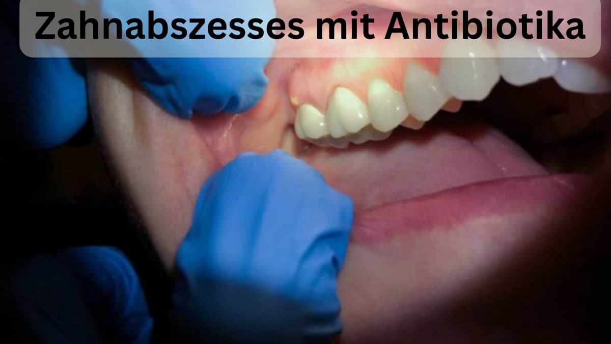 Wie lange dauert die Heilung eines Zahnabszesses mit Antibiotika?